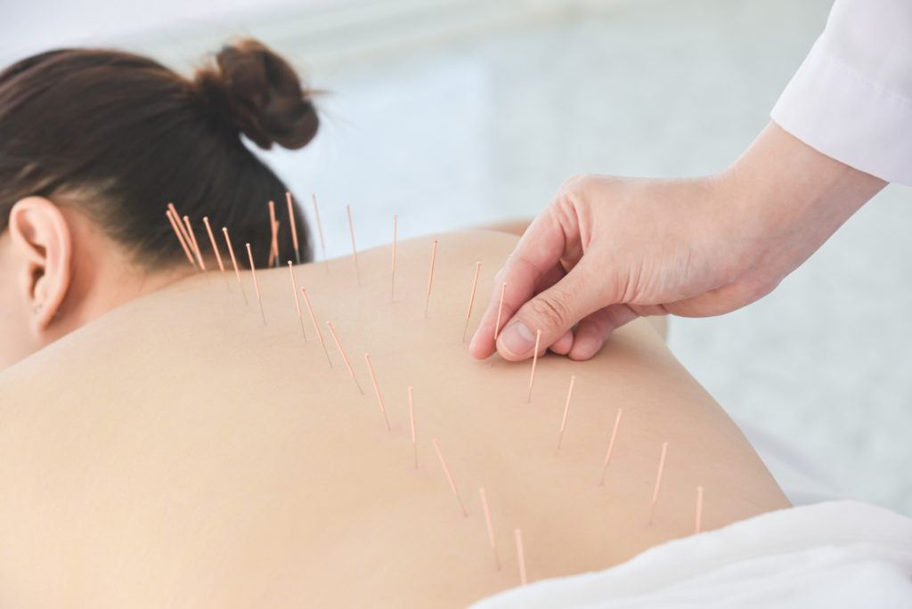 Acupuncture Coral Springs