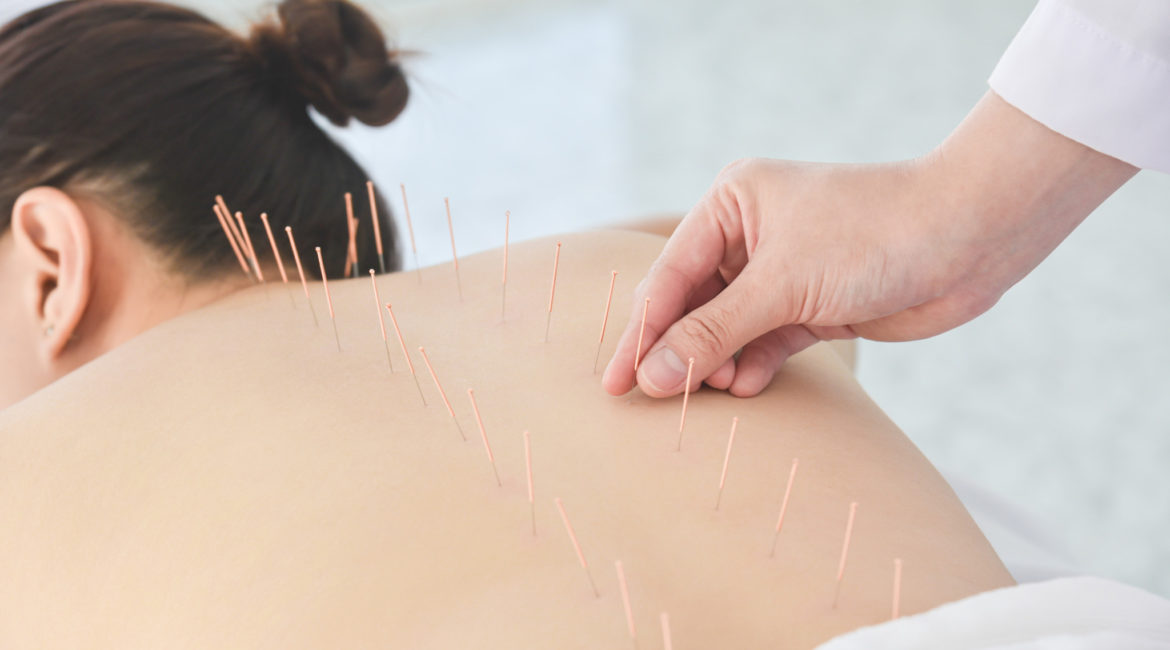 Acupuncture Coral Springs
